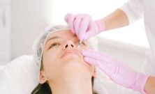 Fillers för läppar: Vad är det och hur fungerar det?